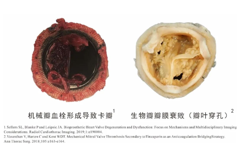 高分子瓣膜企業心銳醫療完成超千萬元天使輪融資，北極光創投獨家投資